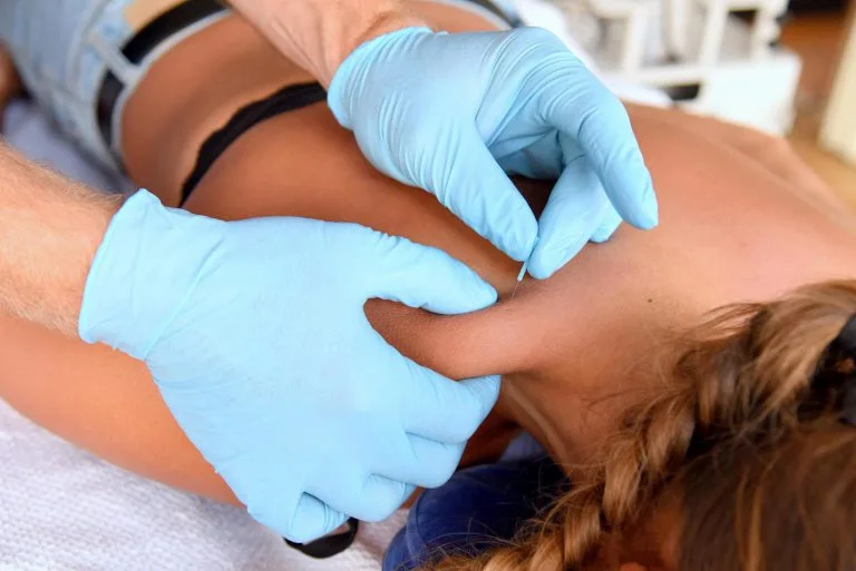 Dry needling
